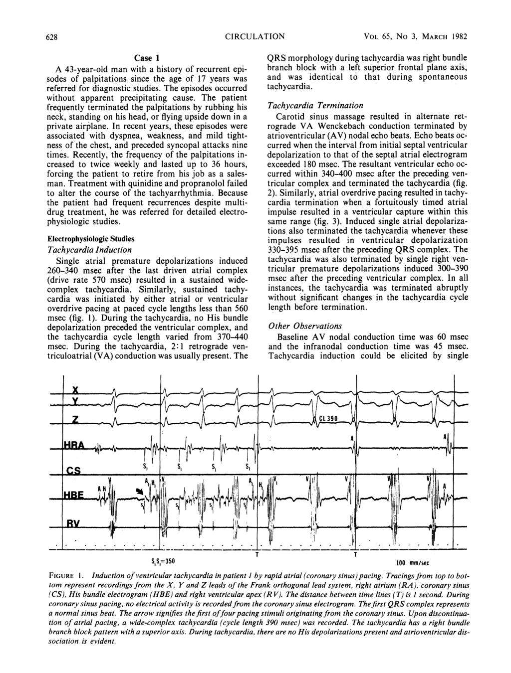 628 CIRCULATION VOL 65, No 3, MARCH 1982 Case 1 A 43-year-old man with a history of recurrent episodes of palpitations since the age of 17 years was referred for diagnostic studies.