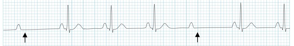 Heart Block 2nd Degree (Mobitz 2) PR Interval is constant QRS complex dropped