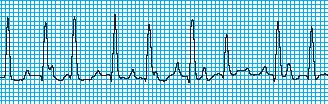 Atrial Tachycardias Appearance Narrow Complex Abnormal P wave morphology Supraventricular = Narrow Complex Sinus Tachycardia Atrial Tachycardia Atrial