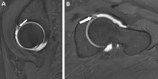 LABRAL TEARS Early diagnosis and treatment of tears is important because it not only provides pain relief but may prevent the early onset of osteoarthritis Causes degeneration