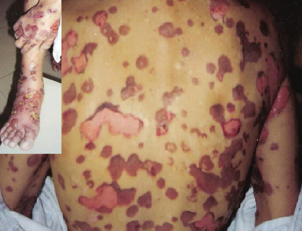 2 Ophthalmology Figure 1: Patient with multiple dermatologic lesions distributed in limbs and back.