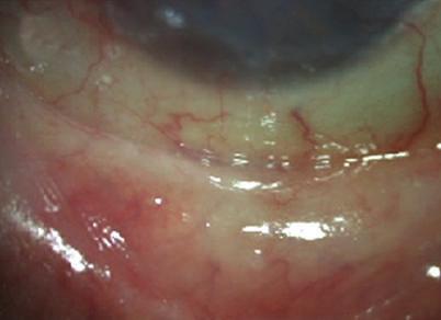 A monolayer of cryopreserved amniotic membrane was implanted in his right eye. We suggested immunoglobulin therapy, but the patient could not obtain the treatment.