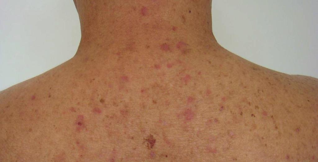 The dermatologic lesions resembling LAD are dermatitis herpetiformis, pemphigoid, epidermolysis bullosa acquisita, and ocular pemphigus vulgaris.