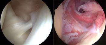 Repair for recurrent shoulder dislocation Less common procedures such as nerve release, fracture repair, and cyst excision can also be performed using an arthroscope.