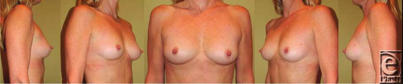 Interesting Case Series Breast Augmentation Sachin M. Shridharani, MD, Justin L. Bellamy, BS, Mark M. Mofid, MD, and Navin K.