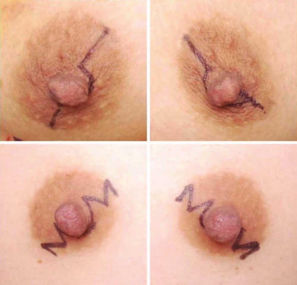 Volume 135, Number 3 Areolar Omega Zigzag Incision Fig. 1. Preoperative design. (Above) Classic transareolar-perinipple incision. (Below) Transareolarperinipple zigzag incision.