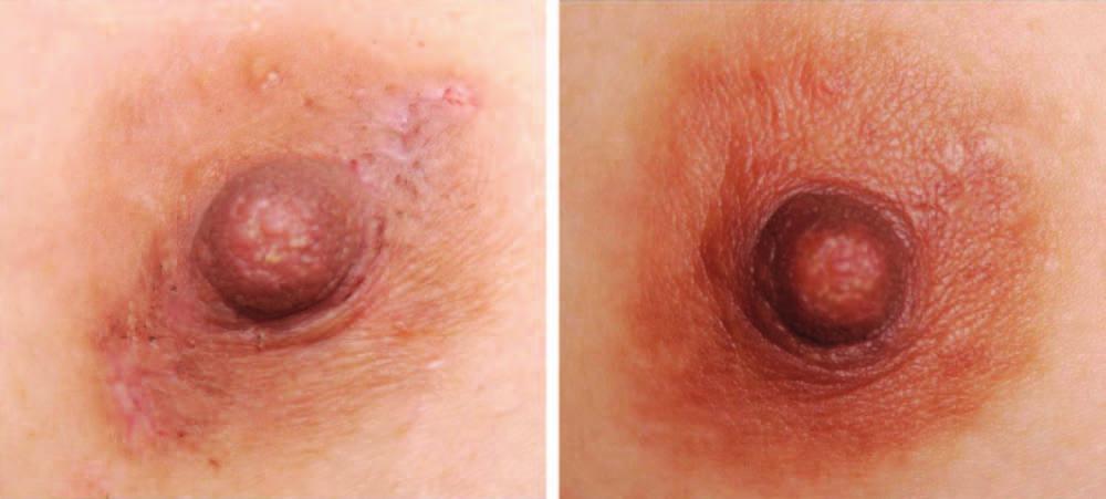 Volume 135, Number 3 Areolar Omega Zigzag Incision Fig. 4. Follow-up photographs of postoperative scarring at 3 weeks (left) and 6 months (right). Table 1.
