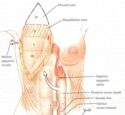 Advances in autologous breast reconstruction Perforator