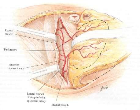 Advances in autologous breast reconstruction