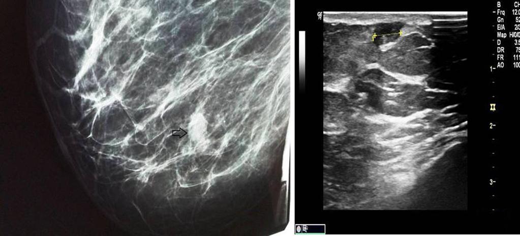 106 Salemis. Sinusoidal hemangioma of the breast A B Figure 1 Mammographic and ultrasonographic findings of sinusoidal breast hemangioma.