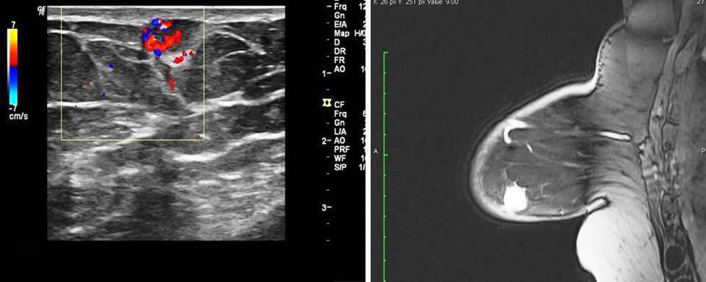 measuring 1 cm 1 cm with microlobulated margins. A B Figure 2 Power Doppler and magnetic resonance imaging findings of sinusoidal breast hemangioma.