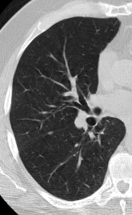 Perifissural lymph node Lung