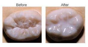 CDC promotes sealants and fluoride as proven strategies to prevent oral disease 1 Sealants: Prevents 88% of decay in permanent molars 2 Plastic resin protects grooves on molars.