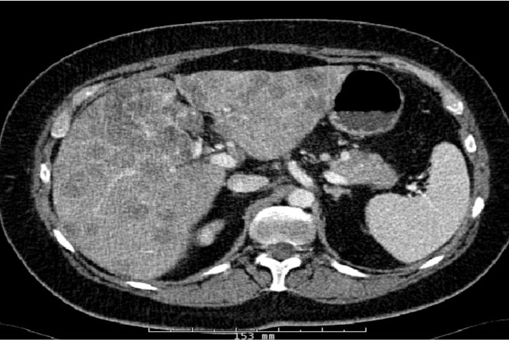 34-year-old female patient This 34-year-old patient was diagnosed with ER- and HER-2/neu positive, PR-negative metastatic breast cancer.