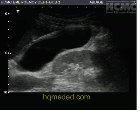 Pericholecystic Fluid Very specific for acute cholecystitis Sonographic