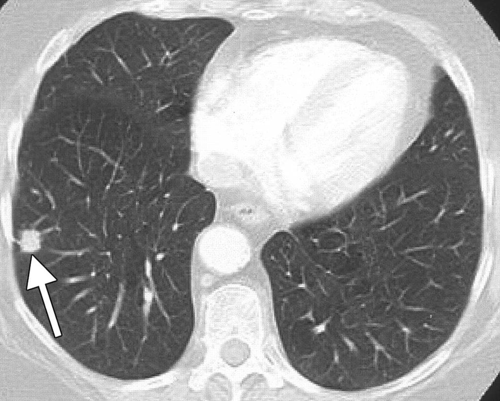 Lung Cancer: Symptoms and Presentation Cough (75%) Hemoptysis (33%) Pain (50%) poor prognostic sign Anorexia and weight loss (poor prognostic sign) Shortness of breath Hoarseness Pleural effusion (if