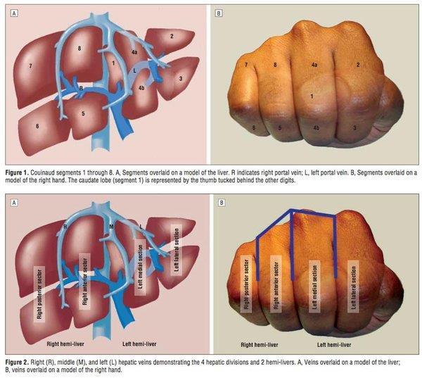 A useful tool to teach segmental liver anatomy Pauli EM, Staveley-O'Carroll KF, Brock MV, Efron DT, Efron G.
