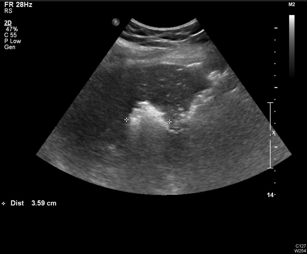 Pt #1: Post-RFA US Hyperechoic lesion due to