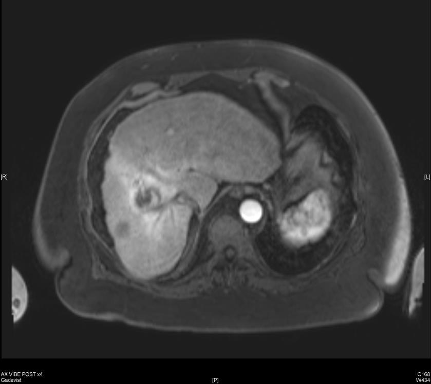 Pt #2: Pre-procedural MRI Band of enhancement in arterial phase Portal venous phase Segment