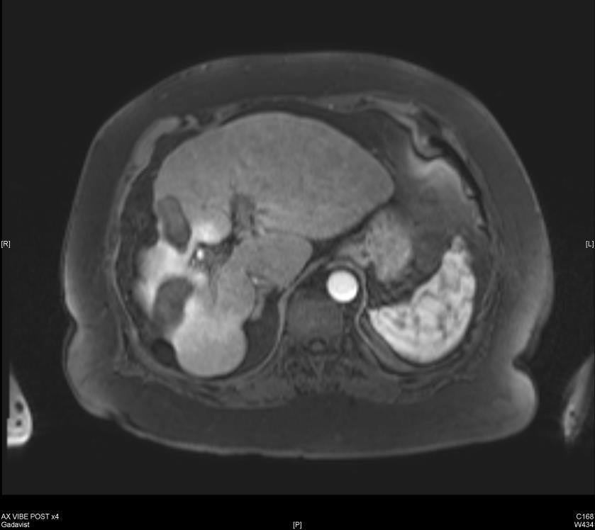 Pt #2: Pre-procedural MRI Hepatic arterial phase Portal venous phase Prior segment V ablation zone Prior segment V