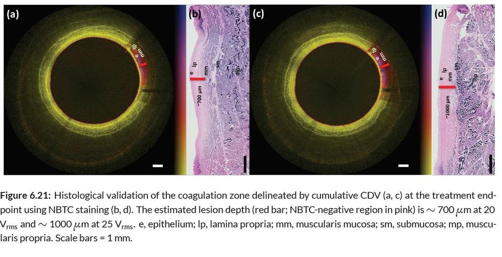 Microscopic image guidance: real-time thermal therapy monitoring for epithelial lesions Novel contrast-free imaging technique to directly visualize the thermal coagulation zone at high resolution in