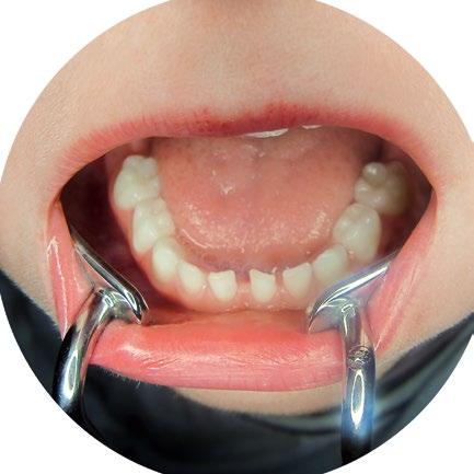 5 cm - In orthodontics, for fitting brackets, etc. - In general dentistry, for filling teeth, root-canal work, etc.