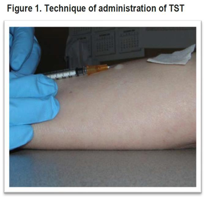 Diagnosis & Treatment of Latent Tuberculosis (LTBI) The selection of people for targeted LTBI