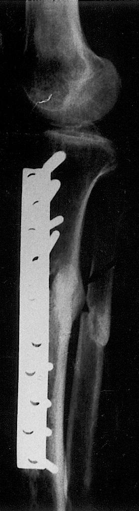 DISCUSSION Fig. 4 Case 2. () Plate fixation with Osteoset T filling in the gap. () Two years after the operation, radiography showed solid union.