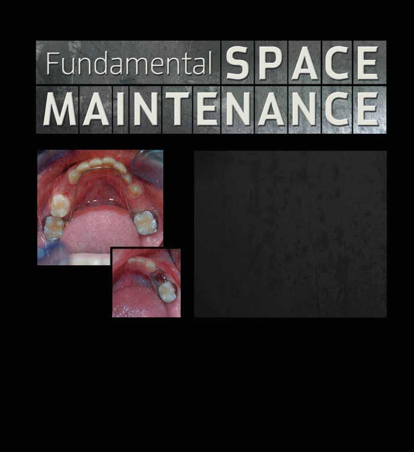 by Josh Wren, DMD Abstract This course is geared toward the general dentist who wants a better understanding in the concept of maintaining space in the primary and transitional dentition.