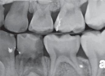 continued from page 97 Space maintenance by simplistic definition is maintaining space in the oral cavity for the proper eruption of the permanent teeth.