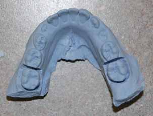 continued from page 99 Between appointments: Pour up model and fabricate lower lingual holding arch, cut area out around the abutment teeth for the bands to be seated on (Figs. 13-16).