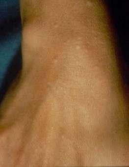 Acral persistent papular mucinosis Rongioletti et al, Arch Dermatol 1986 >