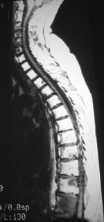 Spinal Metastases Post
