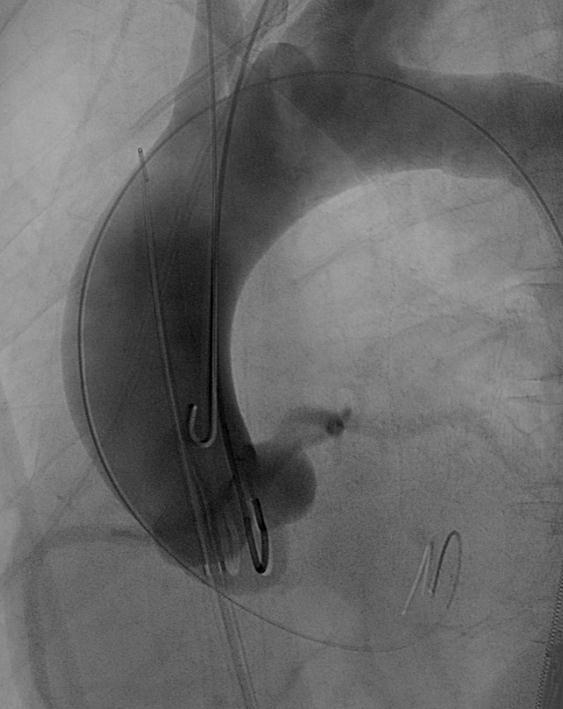 Left ventricular wire-position Crossing the aortic valve: