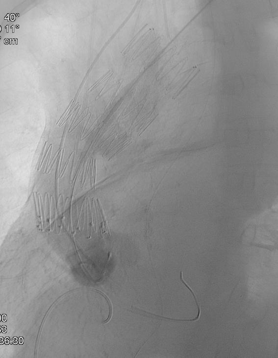 Transsubclavian Access Straight access in