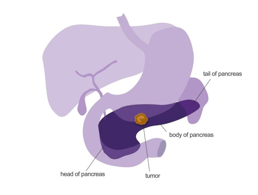 4 What is pancreatic cancer? Pancreatic cancer occurs when abnormal cells in the pancreas grow out of control, forming a mass of tissue called a tumour.
