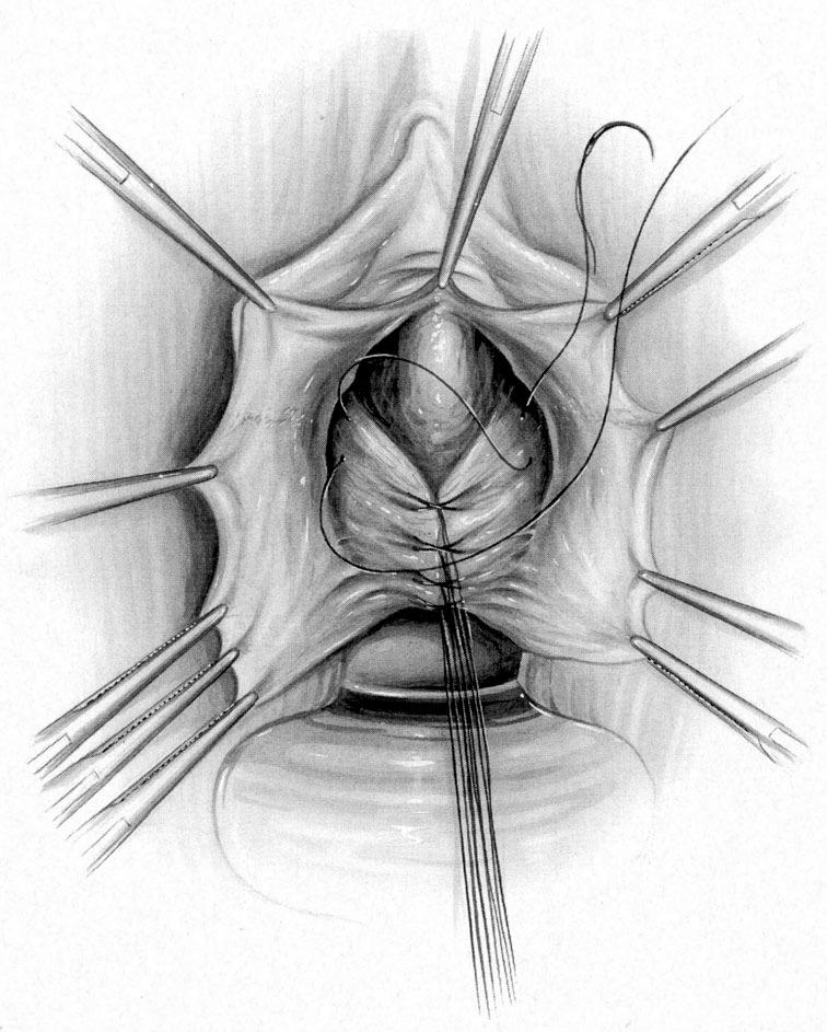Coloprhaphia anterior Indication: Pulsion cystozele Tightening of the anterior vaginal wall Readaptation of the