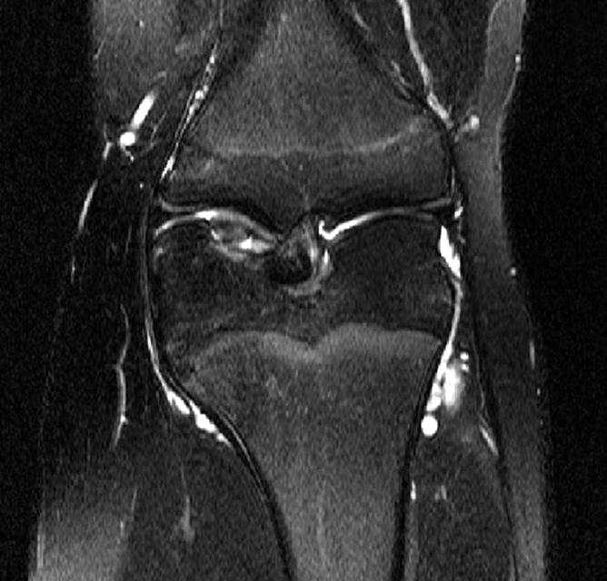 Case Report 15-year-old boy had a 9-month history of left knee pain without trauma. The pain was aggravated during playing soccer one month prior to his presentation to this clinic.