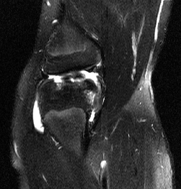 Preoperative computed tomography (CT) showed a large bony defect in the left medial femoral condyle. The size of the lesion was measured as 20 33 mm on CT (Fig. 1C).