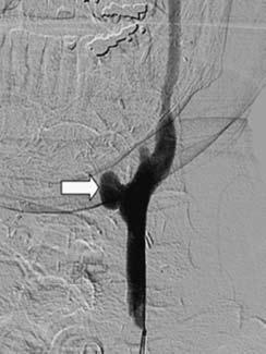 (C) Repeat angiogram after placement of a covered stent (arrows) shows successful exclusion of pseudoaneurysm. Vasospasm is noted above the stent (arrowhead).