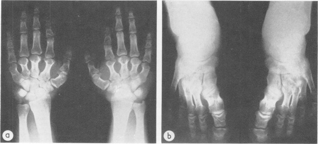 Hereditary Brachydactyly Associated with Hypertension clearance test, intravenous pyelogram, vanyl mandelic acid in 24-hour urine, intravenous regitin test, and renal angiogram.