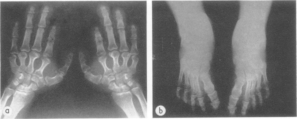 258 Bilginturan, Zileli, Karacadag, and Pirnar FIGS. 5a and 5b. X-rays of the hands and feet of case IV. 12, a 36-year-old male.