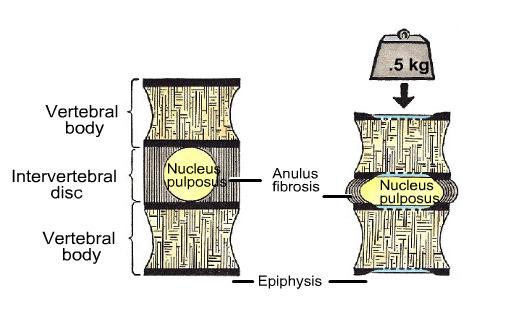 pulposus through the anulus fibrosus of IV disc