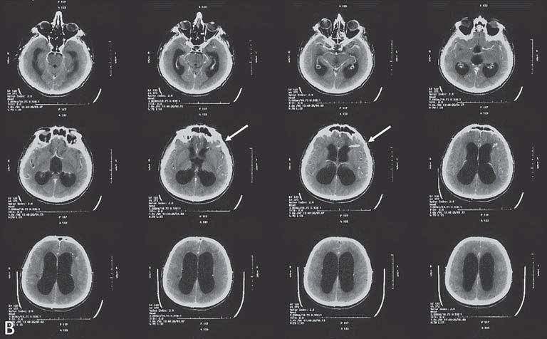 Case Report A 70-year-old man presented to the hospital emergency room with symptoms of weakness, forgetfulness, and frequent urination in the past two months.