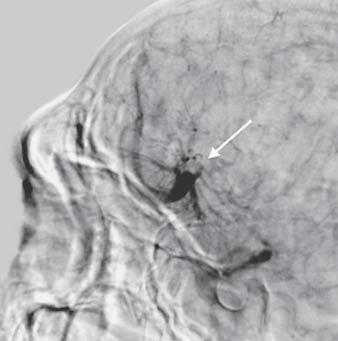 sagittal sinus. The radiologist suggested it could be an AVM or DVA.