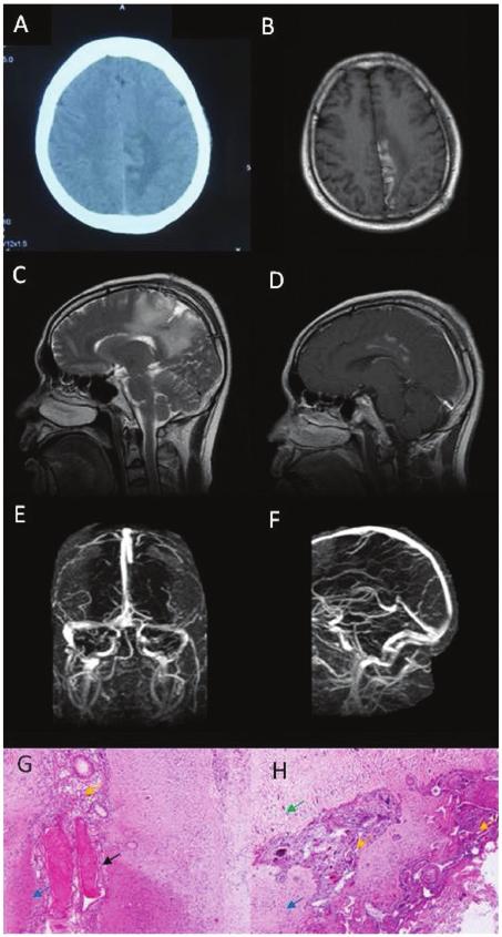 650 YU et al: CORTICAL VEIN THROMBOSIS MISDIAGNOSED AS BRAIN TUMOR of neurons, dilated small veins with congestion or thrombosis, phagocytosis and gliosis, and proliferation of small vessels and