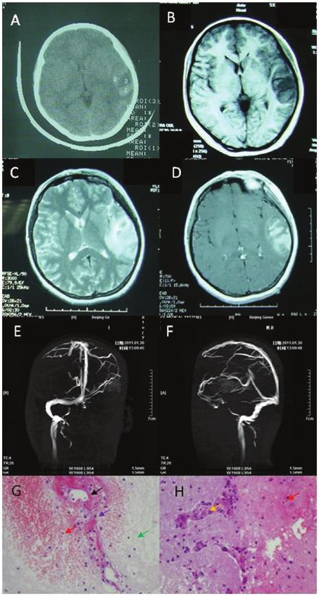 ONCOLOGY LETTERS 11: 649-653, 2016 651 Figure 2. Neuroimaging and pathological studies for patient 2 show evidence of isolated cortical vein thrombosis.