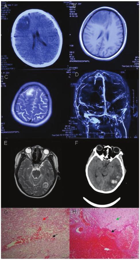 652 YU et al: CORTICAL VEIN THROMBOSIS MISDIAGNOSED AS BRAIN TUMOR Figure 4. Neuroimaging and pathological studies for patient 4 show evidence of isolated cortical vein thrombosis.