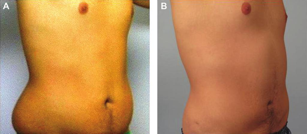 1164 Aesthetic Surgery Journal 33(8) Figure 15. (A) This 23-year-old man presented after massive weight loss of 80 pounds.