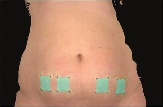 Typically, after injection of tumescent fluid and a modest reduction in the density of subcutaneous fat with SAL, RFAL is applied to achieve the desired thermal and energy end points.